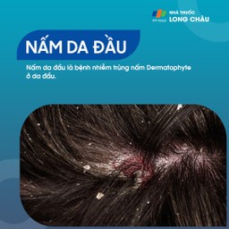 Nấm Da Đầu 1