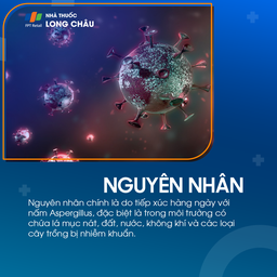 Nhiễm nấm Aspergillus 4