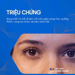 Triệu chứng bọng mắt: Sưng phù và bầm dưới mắt