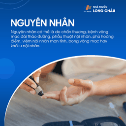 Màng trước võng mạc 3