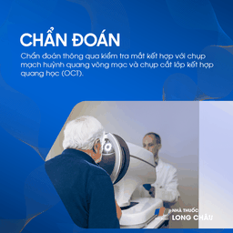 Tắc tĩnh mạch võng mạc 5