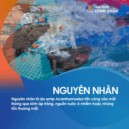 Viêm giác mạc do Acanthamoeba 3