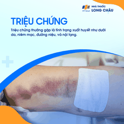 Giảm tiểu cầu miễn dịch 2