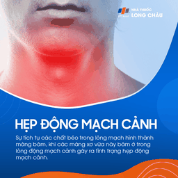 Hẹp động mạch cảnh 1