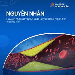 Hẹp động mạch cảnh 3