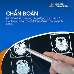 Hẹp động mạch cảnh 5