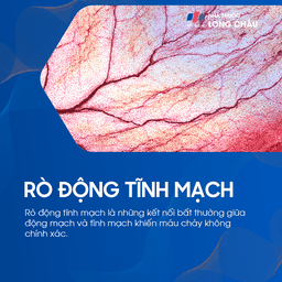 rò động tĩnh mạch 1
