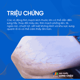 Rò động tĩnh mạch 2