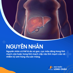Giãn tĩnh mạch thực quản 3