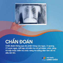 Ngực lỡm bẩm sinh 5