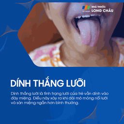 Dính thắng lưỡi 1
