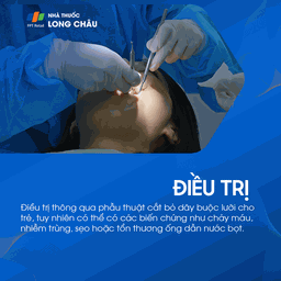 Dính thắng lưỡi 6