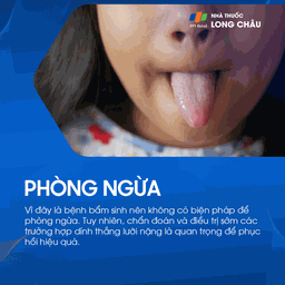 Dính thắng lưỡi 7