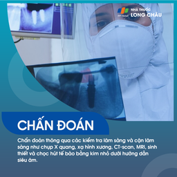 Ung thư nướu răng 5