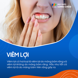 Viêm lợi 1