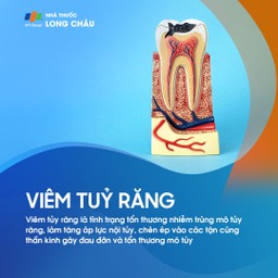 Viêm tủy răng 1