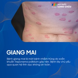 Biểu hiện ngoài da của bệnh giang mai giai