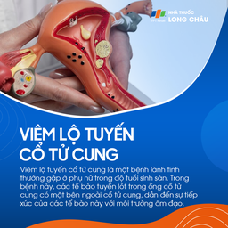 Viêm lộ tuyến cổ tử cung 1