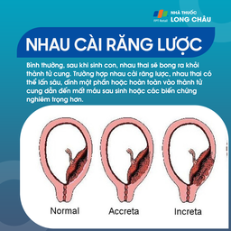 Nhau cài răng lược 1