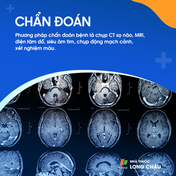 Đột quỵ thiếu máu cục bộ 5