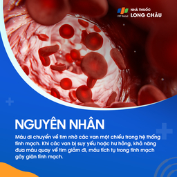 Giãn tĩnh mạch 3