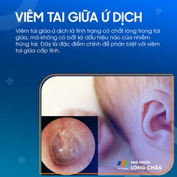 Viêm tai giữa ứ dịch 1