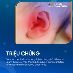 Viêm tai giữa ứ dịch 2