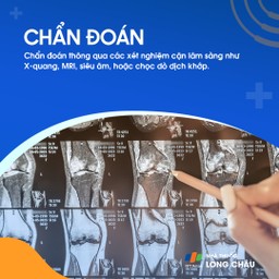 Hẹp khe khớp gối 5