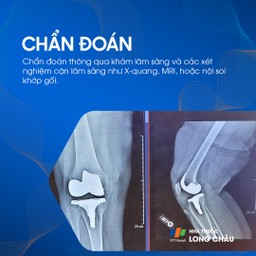 Rách sụn chêm khớp gối 6