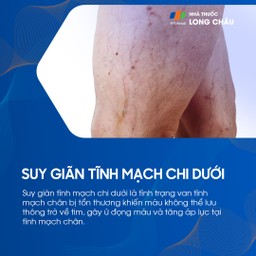 Suy giãn tĩnh mạch chi dưới 1
