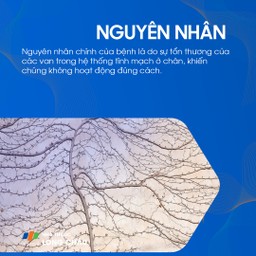 Suy giãn tĩnh mạch chi dưới 3