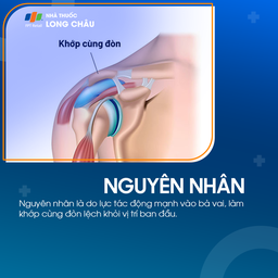 Trật khớp cùng đòn 3