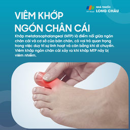 Viêm khớp ngón chân cái 1