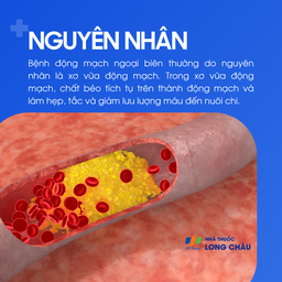 Bệnh động mạch ngoại biên 3