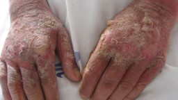 Bệnh Pellagra là bệnh gì? Một số điều cần biết về bệnh Pellagra 2