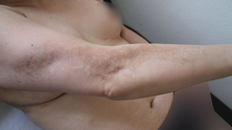 Bệnh tăng trương lực cơ thần kinh là gì? Nguyên nhân, triệu chứng, điều trị và cách phòng ngừa 1