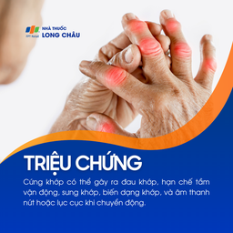 Cứng khớp gây đau, sưng, biến dạng khớp và có tiếng kêu khi vận động