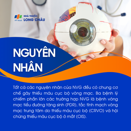 Glocom tân mạch 3