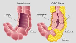 Bệnh Crohn: Nguyên nhân, triệu chứng, phương pháp điều trị 1