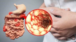 Bệnh Crohn: Nguyên nhân, triệu chứng, phương pháp điều trị 2