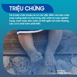 Bàn Chân Khoèo 2