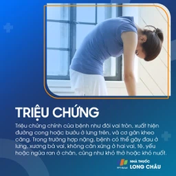 Gù Lưng 2