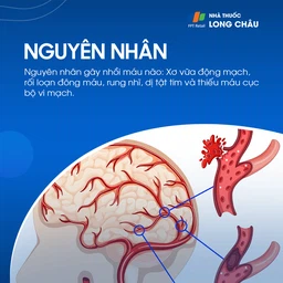 Đột quỵ não 3