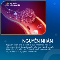 Nguyên nhân gây bệnh nhồi máu não chủ yếu do tắc nghẽn mạch máu trong nã