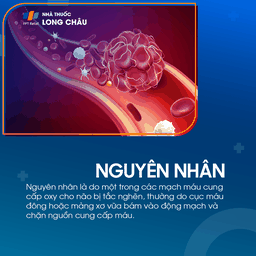 Cơn thiếu máu não cục bộ thoáng qua 3
