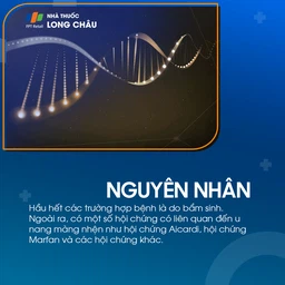 U nang màng nhện não 4