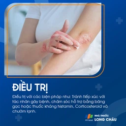 Điều trị viêm da do tiếp xúc bằng kem chống viêm và thuốc bôi giảm ngứa