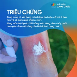 Bỏng da 2