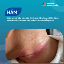 Hăm 1