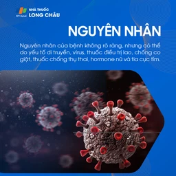 Lupus ban đỏ 3